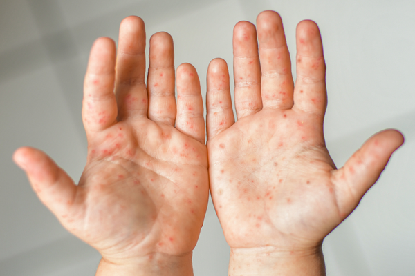 Sở Y tế TPHCM cảnh báo tác nhân EV71 xuất hiện trở lại