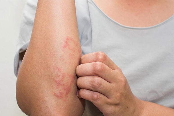 Đề phòng những bệnh về da trong mùa lạnh