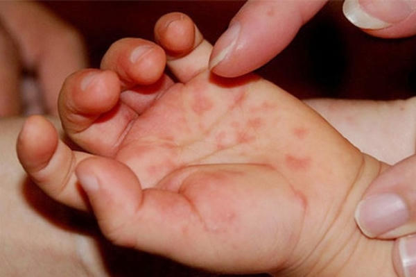 Gia tăng ca mắc tay chân miệng, Bộ Y tế yêu cầu tăng cường kiểm soát dịch