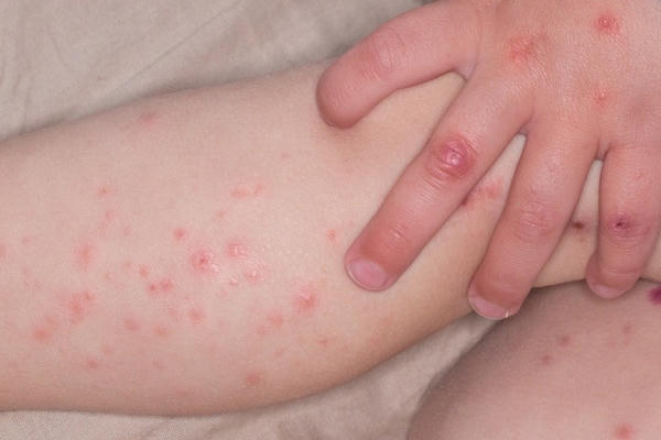 Dấu hiệu tay chân miệng trở nặng, cha mẹ không được chủ quan