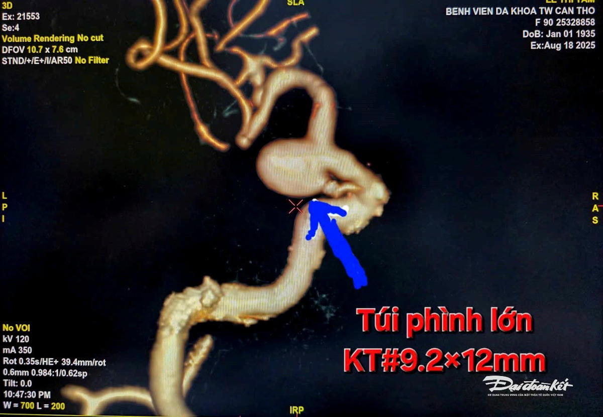 Túi phình mạch máu nảo kích thước lớn trước can thiệp. Ảnh NN.