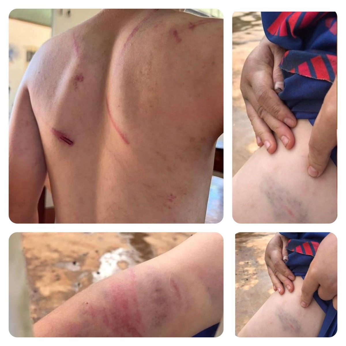 Công an huyện Cư Kuin cho biết, kết quả giám định xác định, cháu T.N.A. bị thương tích 11%. 