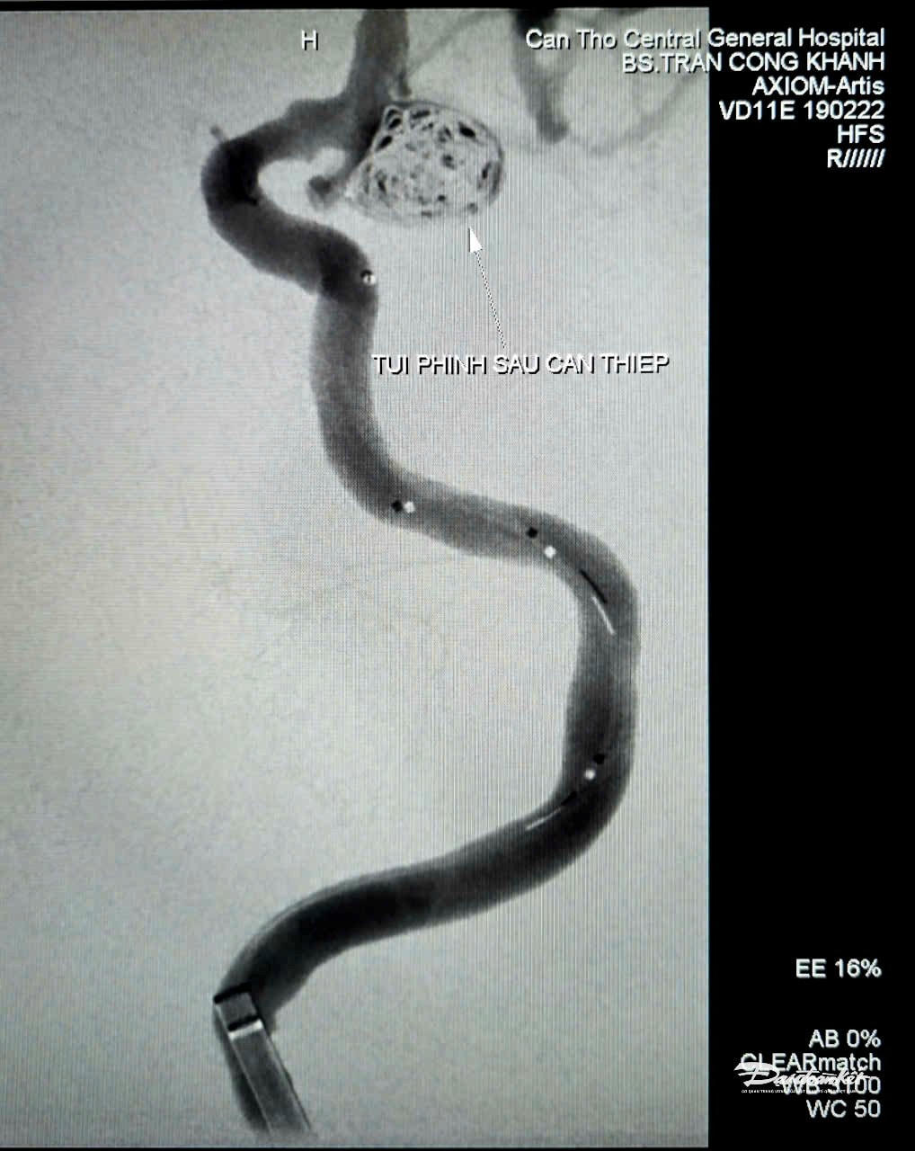 Hình ảnh túi phình mạch nảo sau can thiệp