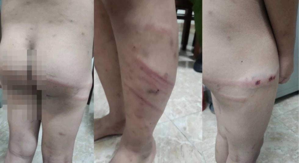 Những vết thương trên người cháu M. nghi do mẹ ruột và bạn trai gây ra. Ảnh: Xuân Nguyễn.