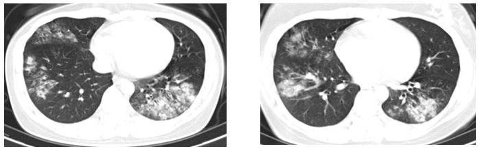 Phim chụp cắt lớp vi tính ngực của người bệnh bị viêm phổi cộng đồng