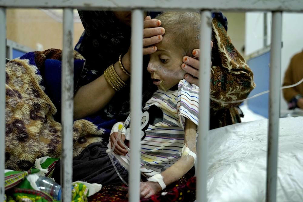 Những đứa trẻ suy dinh dưỡng nghiêm trọng ở Afghanistan. Ảnh: AP.