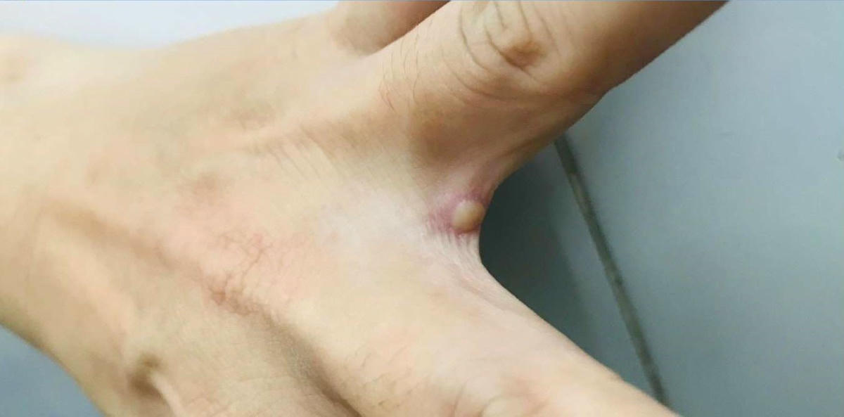 TP HCM phát hiện ca đậu mùa khỉ đầu tiên. 