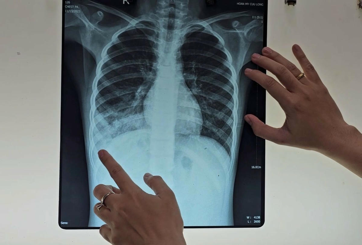 x-quang-truoc-dieu-tri.jpeg