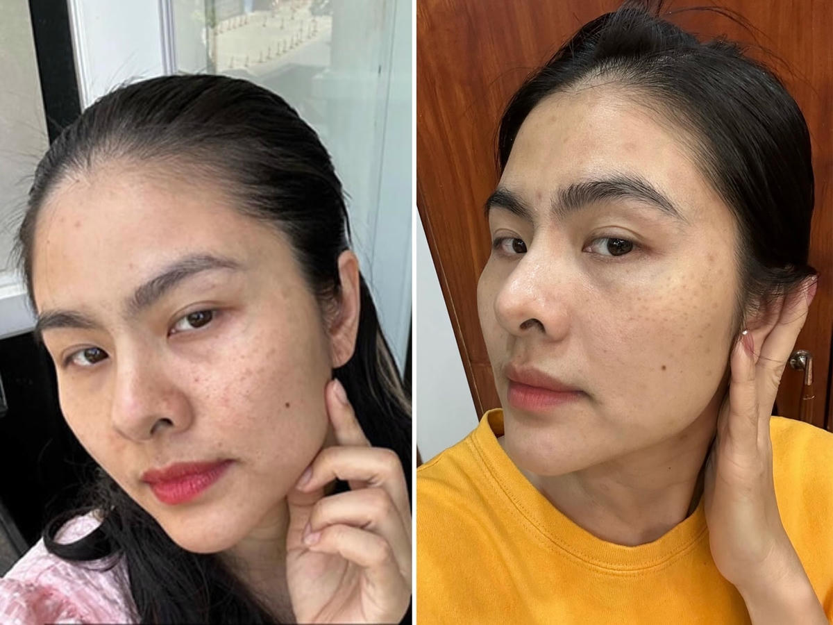 Tình trạng da Vân Trang bị nám, sạm, thiếu sức sống.