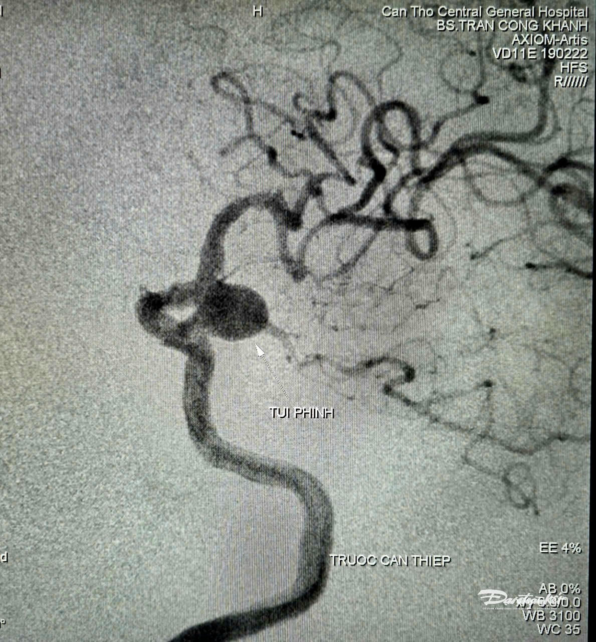 Túi phình mạch nảo trước can thiệp. Ảnh NN.
