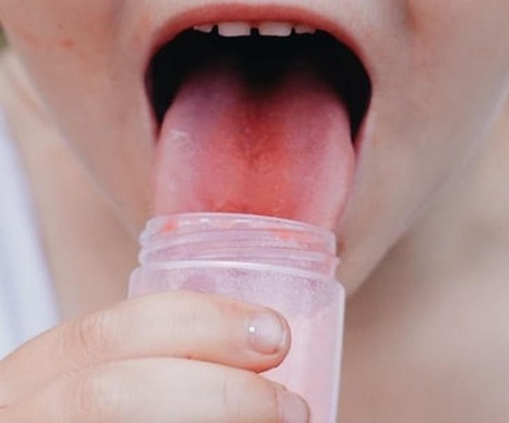 9 cách chữa lành vết bỏng lưỡi sau khi ăn đồ nóng