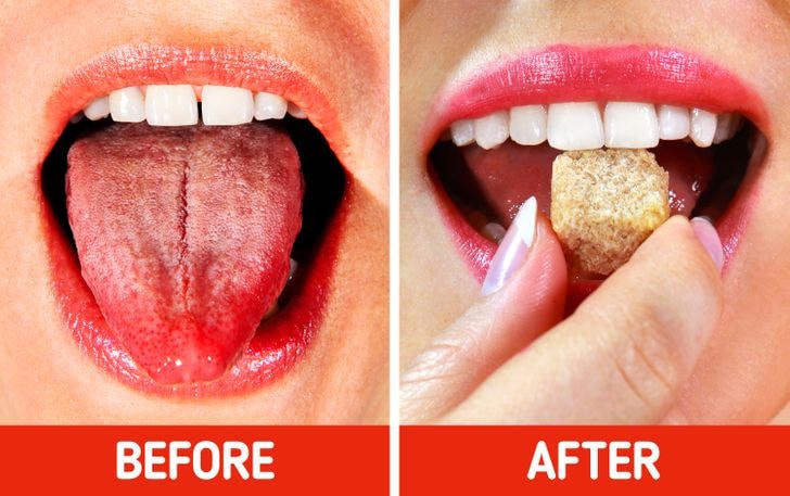 9 cách chữa lành vết bỏng lưỡi sau khi ăn đồ nóng