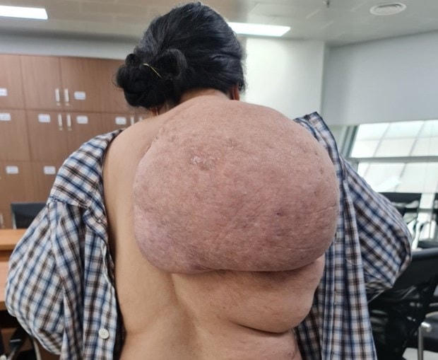 Khối u trên bả vai của bệnh nhân. (Ảnh: PV/Vietnam+).