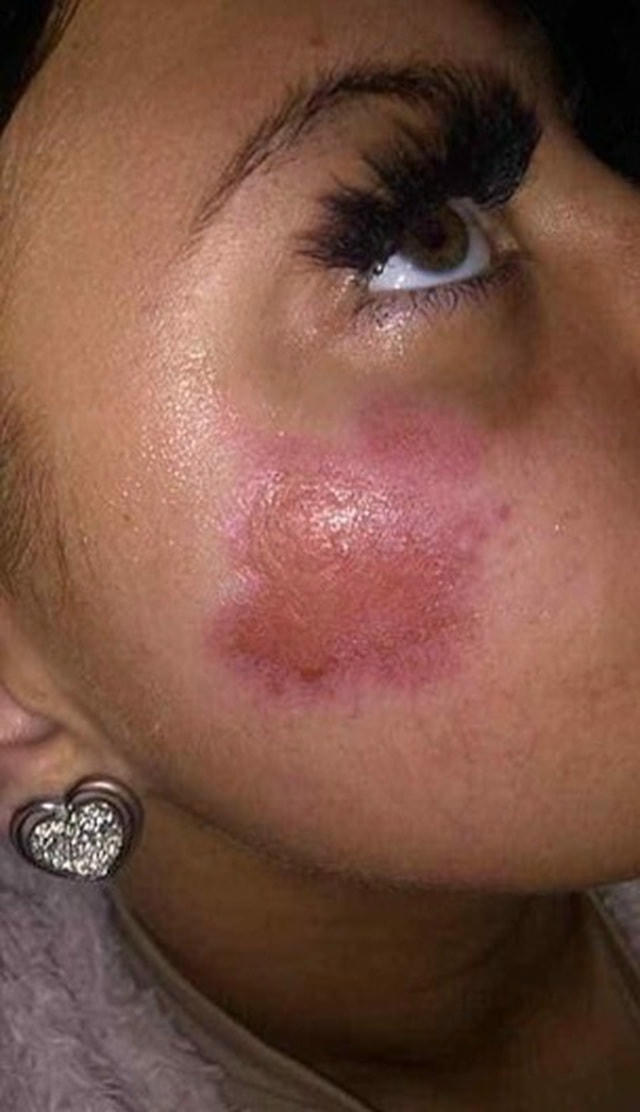 Vết bỏng trên mặt Amie Hall sau vụ nổ.