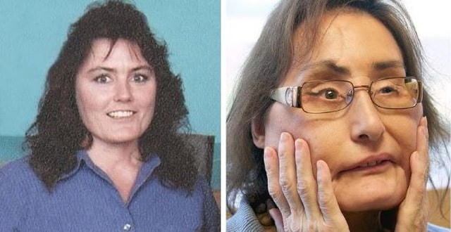 Bà Connie Culp trước và khi được ghép mặt. Ảnh: AP.