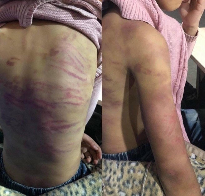Bé gái 12 tuổi bị mẹ bạo hành, trên người vô ố vết thương.