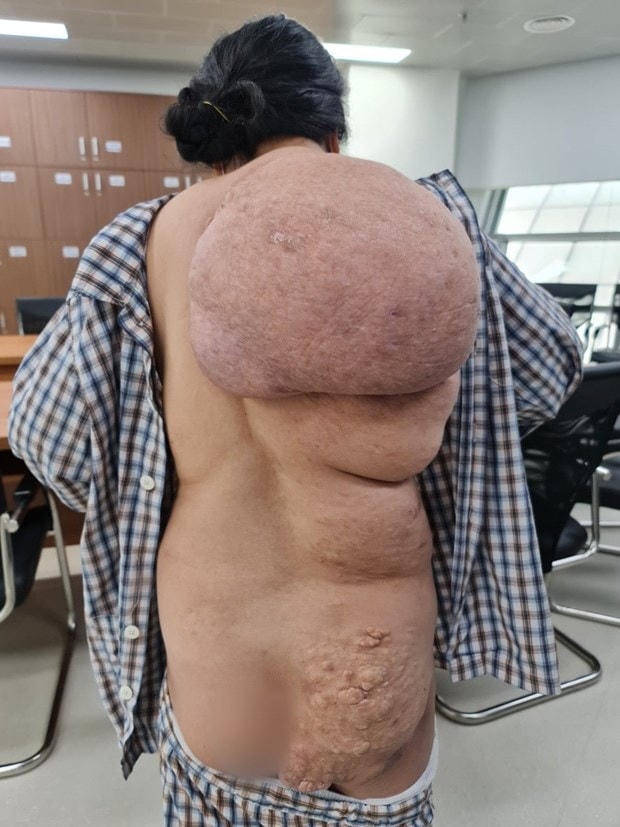 Bệnh nhân trước khi phẫu thuật với khối u