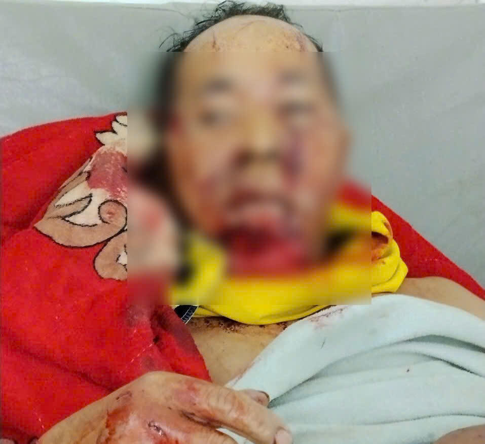 Ông Pơloong Nh. điều trị tại bệnh viện. Ảnh: CV.