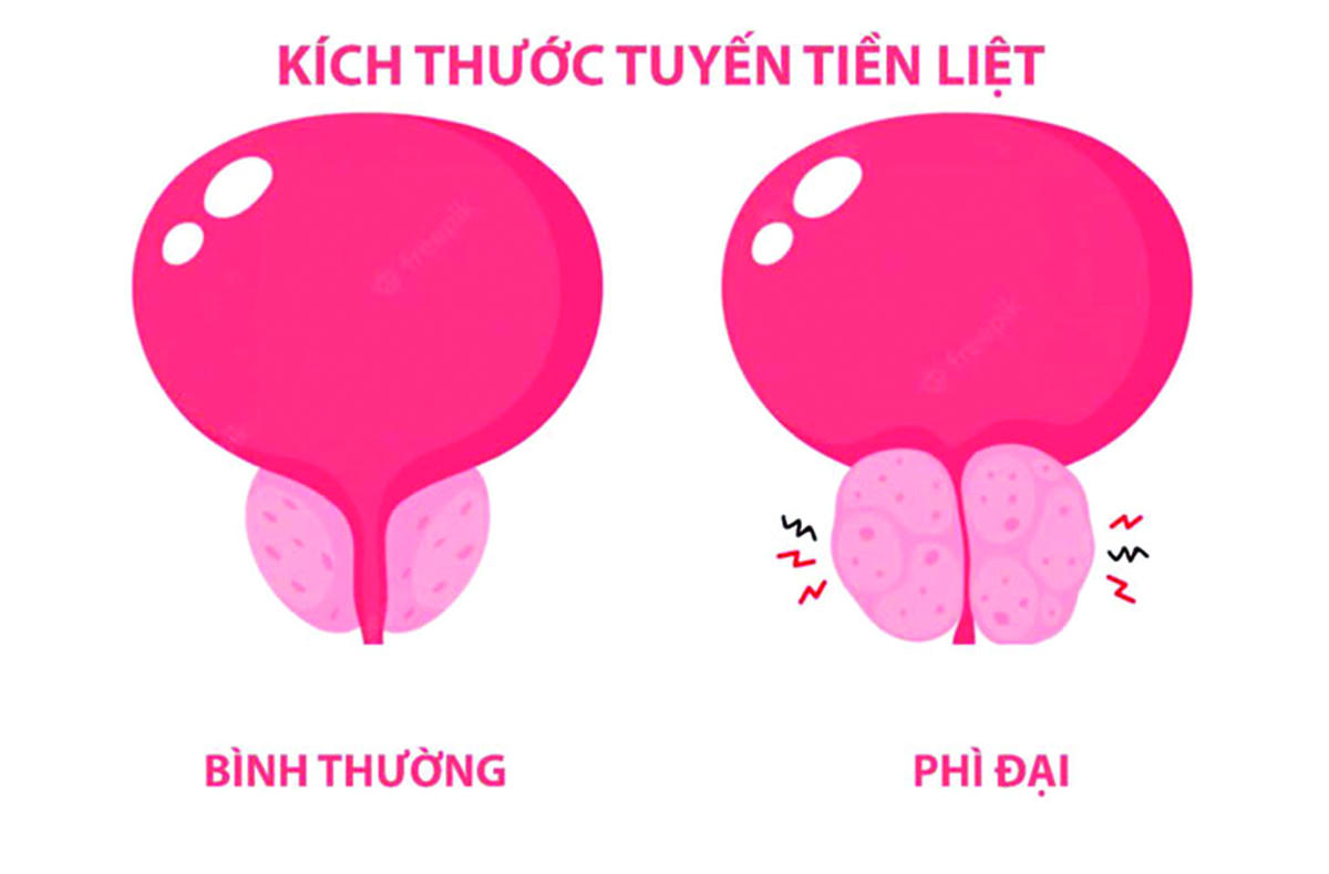 Điều trị phì đại tiền liệt tuyến
