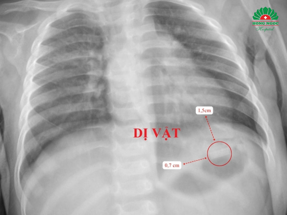 Vị trí dị vật trên phim chụp X-quang&nbsp;