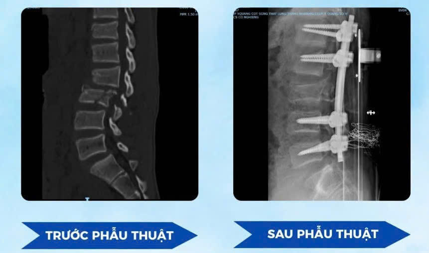 Phẫu thuật cố định cột sống cho bệnh nhân. Ảnh: BVCC.