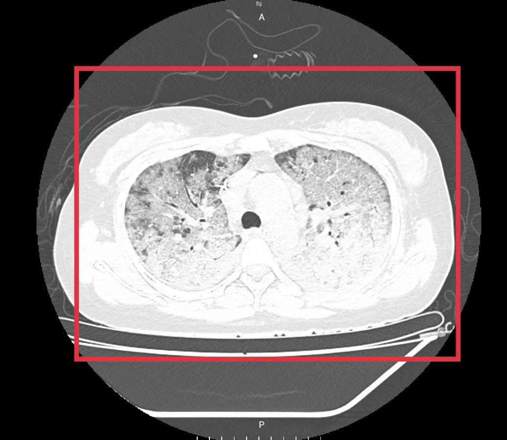 Hình ảnh chụp phổi của bệnh nhân. Ảnh: BVCC.