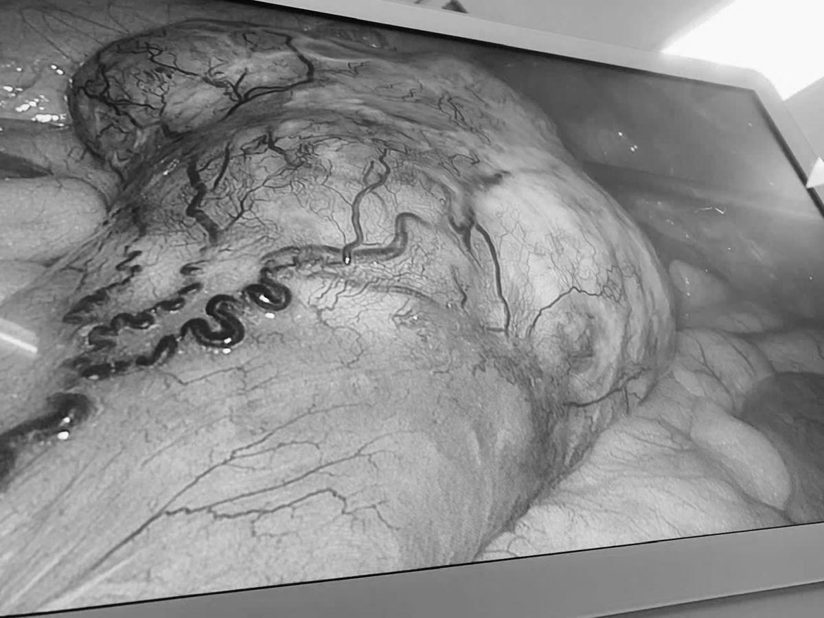 Hình ảnh khối u được quan sát qua nội soi. Ảnh BV