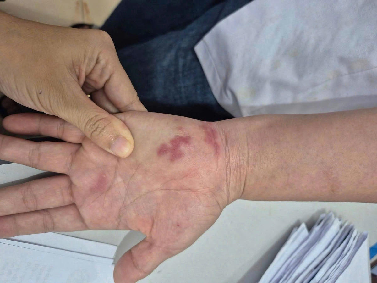 Cụ ông 70 tuổi nhiễm vi khuẩn 'ăn thịt người' sau khi bị vây cá đâm