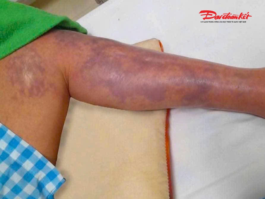 Bệnh nhân xuất hiện các triệu chứng bất thường như sốt cao, mệt mỏi, vùng da quanh vết thương nổi nhiều bóng nước, đau rát dữ dội