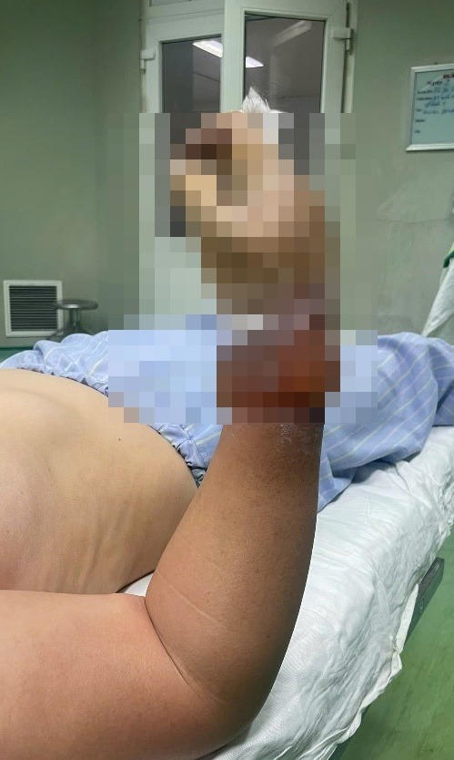 Tai nạn điện giật khi dựng cây nêu ở Nghệ An, một phụ nữ bị bỏng nặng