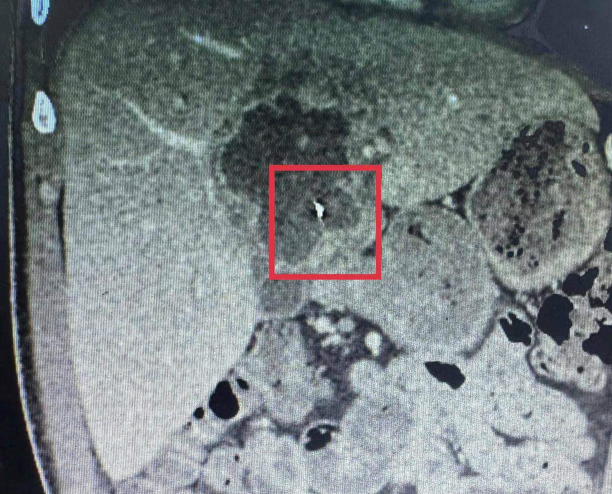 Hình ảnh CT-scan vị trí ổ áp xe gan (khoanh đỏ). Ảnh: Trung Ngãi