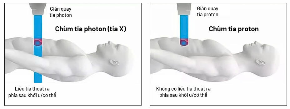 Xạ trị photon (tia X) đưa liều xạ vào khối u nhưng vẫn có thể “đi xuyên qua” phía sau, có thể gây tổn thương mô lành quanh đường đi của tia; trong khi đó xạ trị proton hiện đại với tia năng lượng biết “dừng đúng chỗ” ngay vị trí khối u để tiêu diệt khối u hiệu quả và an toàn cao