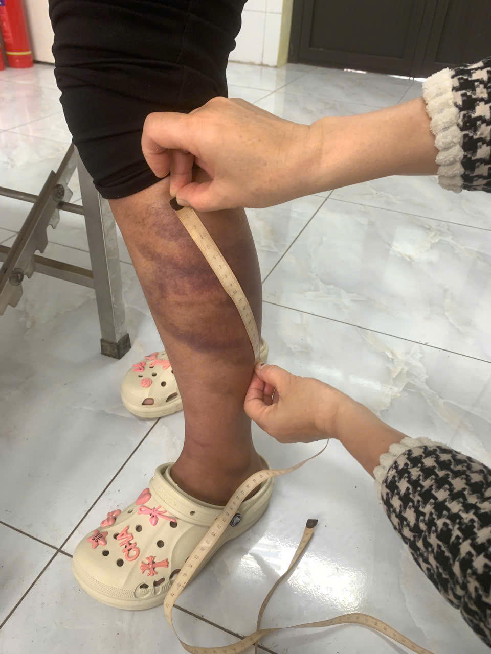 Cháu Phan Thị M.T. bị bố đẻ đánh gây thương tích.