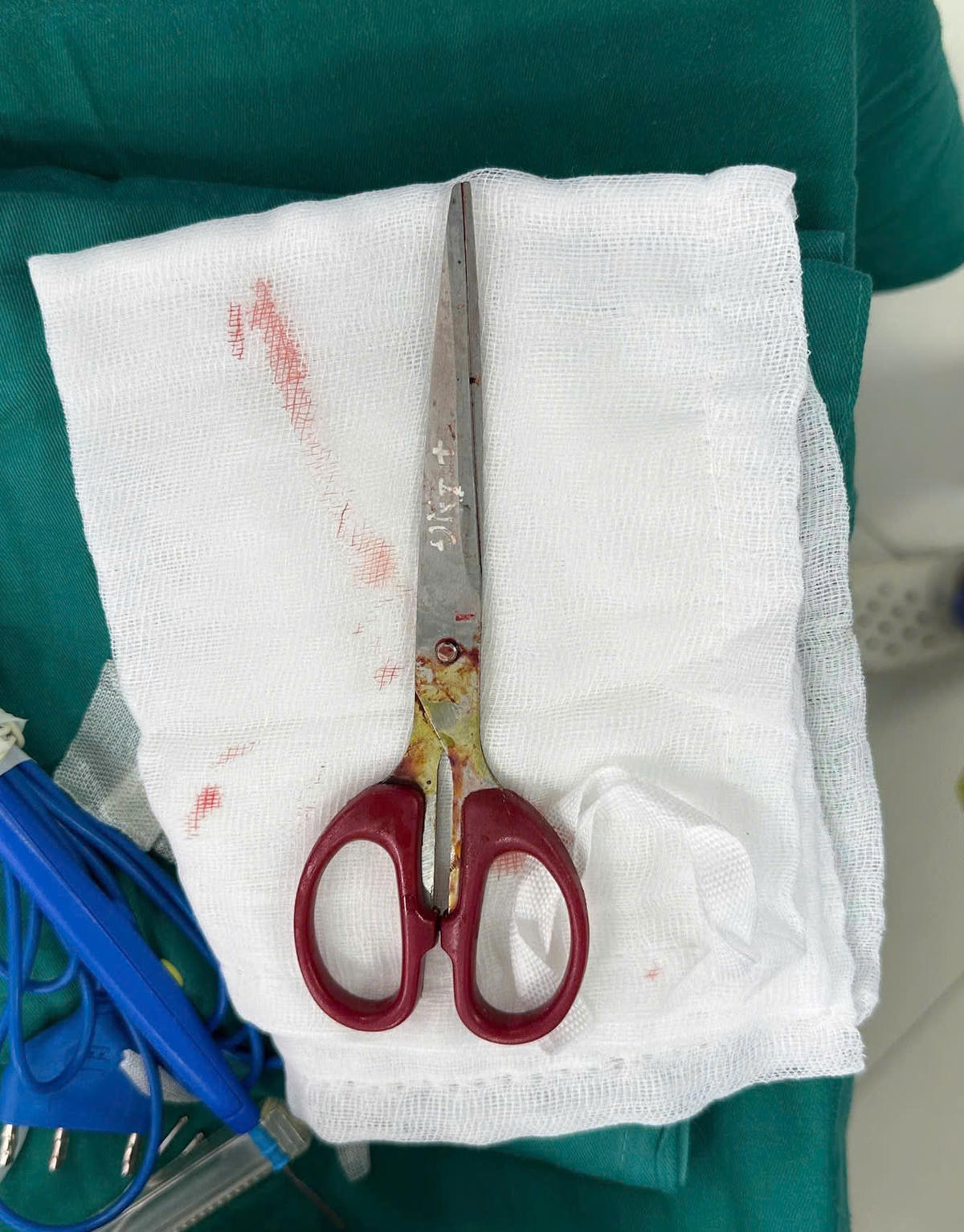 Hình ảnh dị vật sau khi được lấy ra (ảnh BVCC)