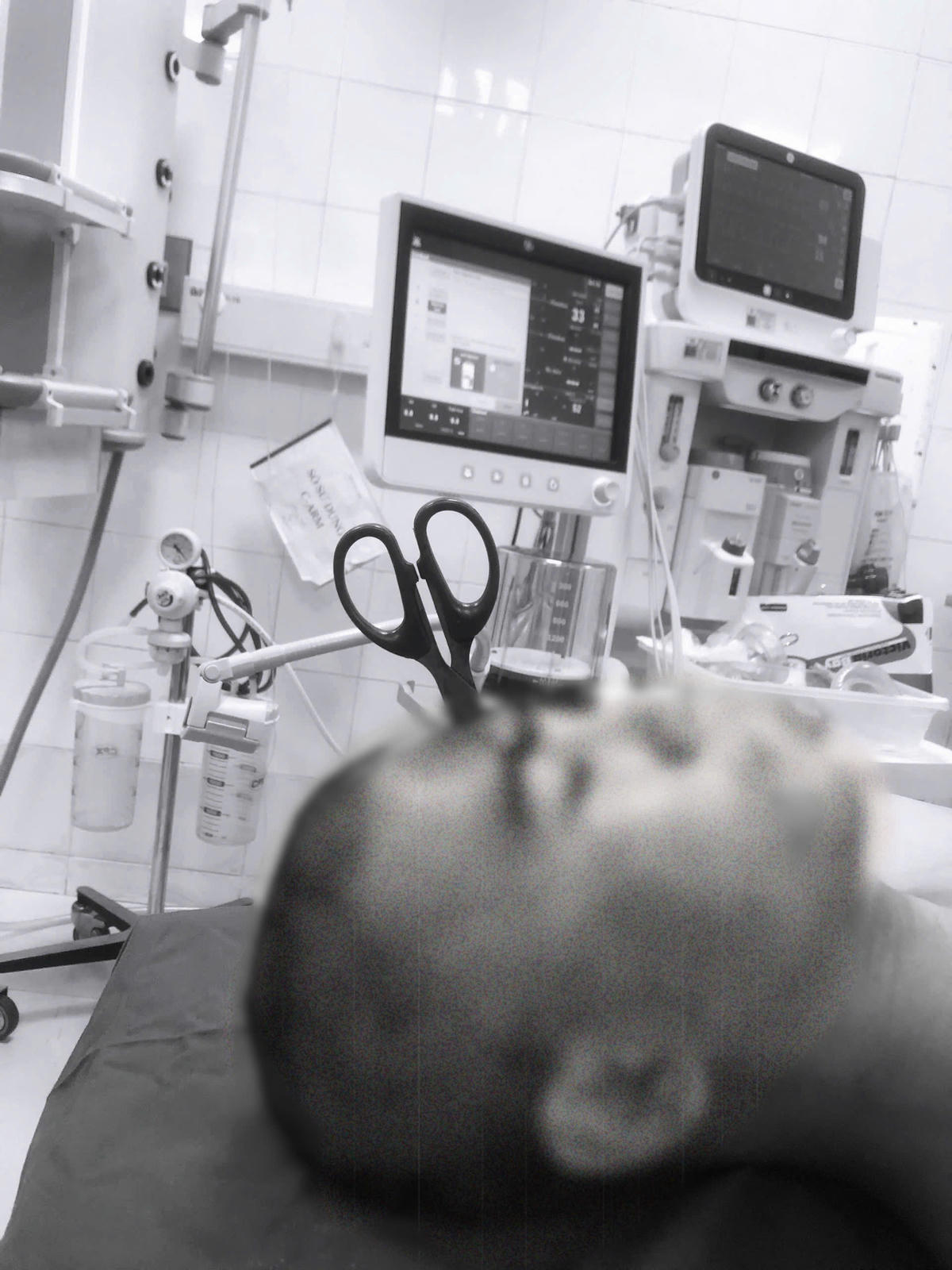 Hình ảnh kéo xuyên đầu người bệnh trẻ