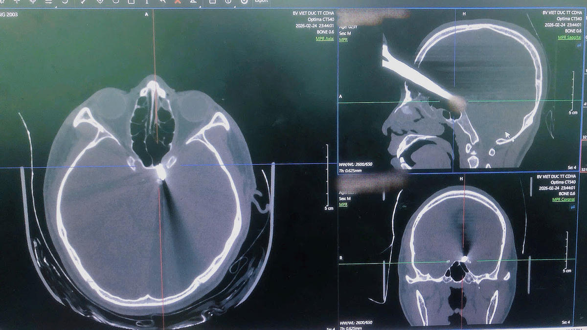 Hình ảnh phim chụp CT phát hiện dị vật