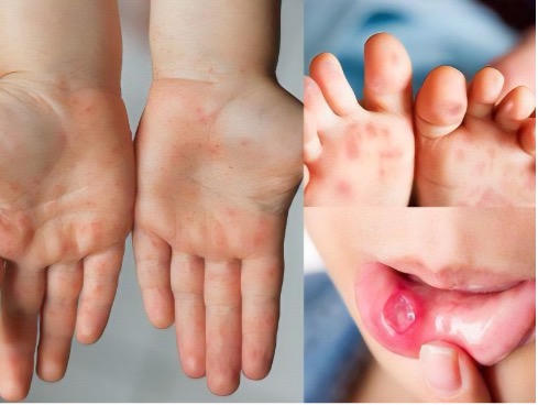 Trẻ nổi ban khi mắc bị tay chân miệng. Ảnh: HCDC