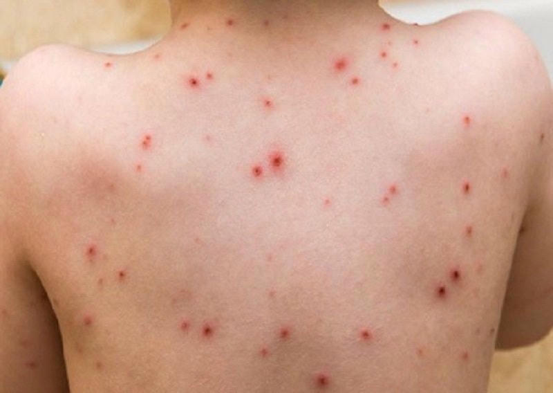 Việt Nam đã ghi nhận 4 trường hợp mắc bệnh đậu mùa khỉ.