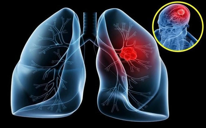 90% bệnh nhân ung thư phổi do hút thuốc lá.