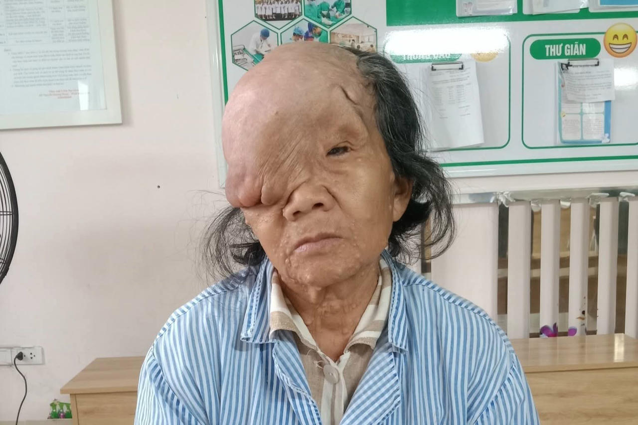 Bà Lê Thị Thành bị u bã đậu giai đoạn cuối, hoàn cảnh rất khó khăn. Ảnh: Thành Tâm