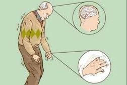 Người mắc bệnh Parkinson cần tập phục hồi chức năng
