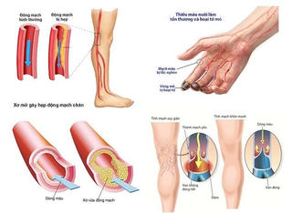 Bệnh lý mạch máu ngày càng trẻ hóa