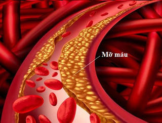 Không thể coi thường mỡ máu cao  