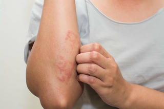Nắng nóng, tăng bệnh nhân mắc bệnh ngoài da