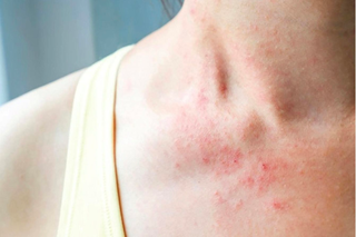 Những cách giúp hạn chế tác nhân gây viêm da dị ứng trong mùa lạnh