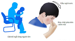 Làm gì khi trẻ bị chảy máu cam?