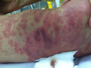 Hà Nội ghi nhận ca viêm não mô cầu đầu tiên