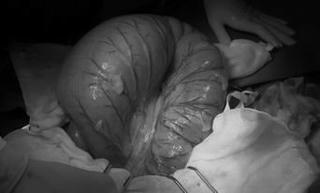 Điều trị thành công ca bệnh xoắn đại tràng sigma hiếm gặp ở trẻ em