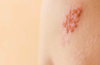 Bệnh Zona có phòng ngừa được bằng vaccine không?