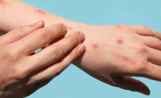 TP HCM: Ca đậu mùa khỉ thứ hai có thể bị lây nhiễm từ ca đậu mùa khỉ thứ nhất